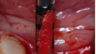 Minimalinvasive autologe Knochenaugmentation