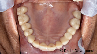 Digitale Präzision und Ästhetik – Sofortimplantation im Frontzahnbereich