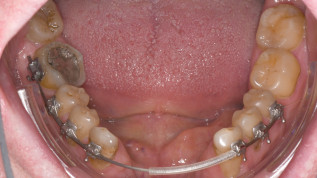 Distraktionsosteogenese im Unterkiefer