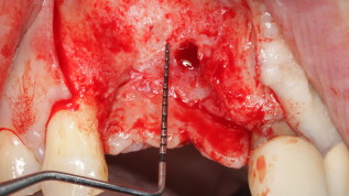 Die chirurgische Behandlung der Periimplantitis