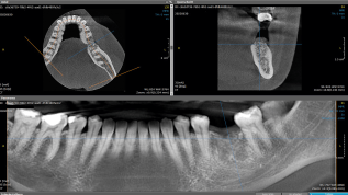 Möglichkeiten von zweiteiligen Keramikimplantaten