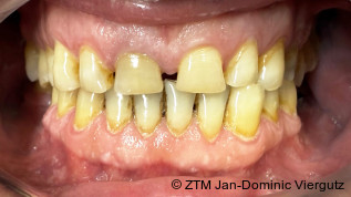 Ästhetische und funktionelle Rehabilitation mit Multilayer-Zirkonkronen