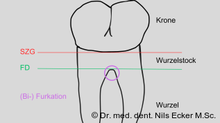 Update resektive Parodontalchirurgie: Behandlungsstufe 3 bei Parodontitis Stadium I–III