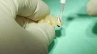 In 5 Schritten zur intraoralen Reparatur