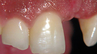 Nichtoperative Reparatur einer zervikalen Resorption