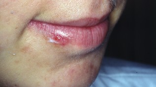 Update Laseranwendungen in der Zahnheilkunde