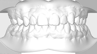 Aligner Attachments: Effizient hergestellt