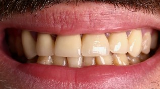 Ästhetische Rehabilitation der Oberkieferfront unter Erhalt der biologischen Breite