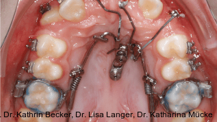 Kieferorthopädische Implantate für orthodontische und orthopädische Maßnahmen