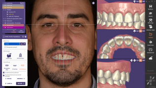 Neue Features des Moduls Smile Creator von exocad