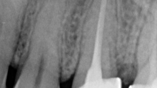 Minimalinvasive Wurzelspitzenresektion: Easy-Guided WSR