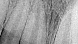 Therapie nach Spätfolgen eines Frontzahntraumas