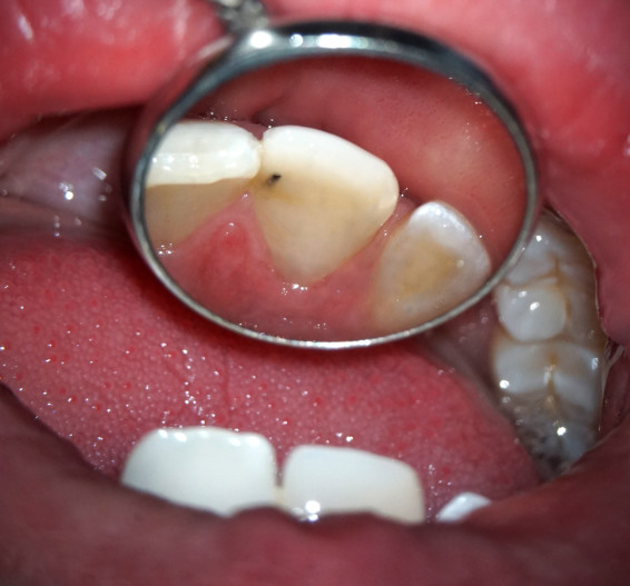 Provisorische füllung wurzelbehandlung Zahnschmerzen nach