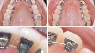 Exzellenz und Evidenz in der Patientenversorgung mit Lingualer Orthodontie