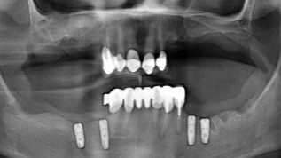 Biologische GBR und Keramikimplantate – Teil 2