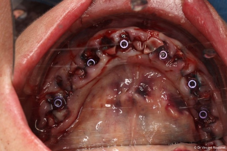 Fig. 10: GBR performed and copaSKY uni.cone abutments placed.