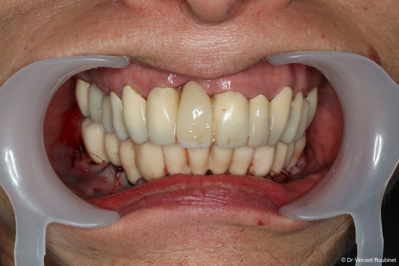 Fig. 11a: Immediate PMMA provisional prosthesis.