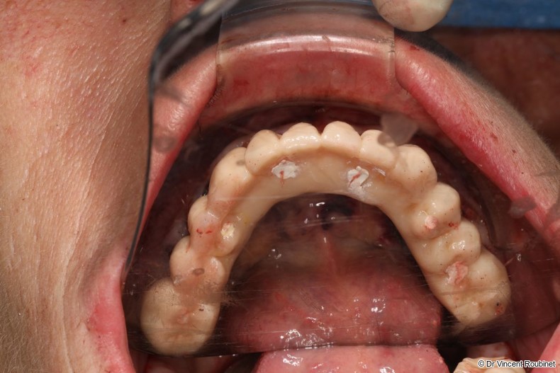 Fig. 11b: Occlusal view of the provisional prosthesis.