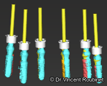 Fig. 12: Superimposition of the virtual plan and the segmented actual implant positions.