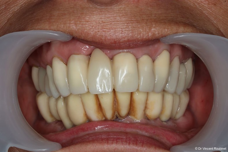Fig. 13: Three-month postoperative follow-up.