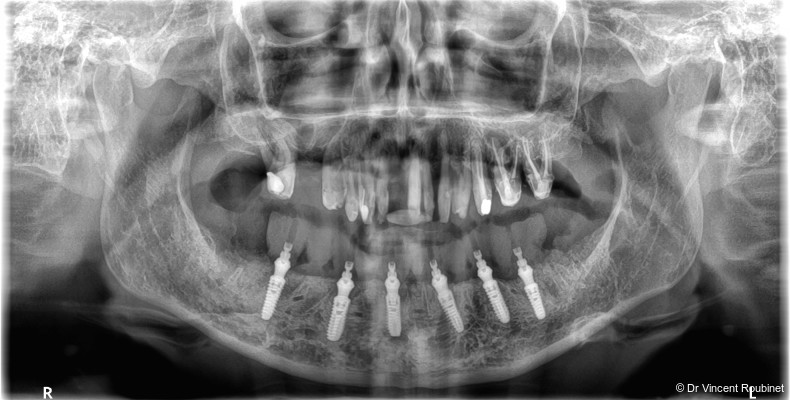 Fig. 15a: Immediate postoperative OPG.