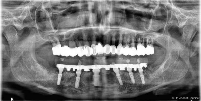 Fig. 16a: OPG of definitive prosthesis at six month post implant placement.