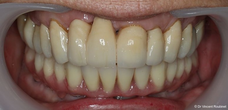 Fig. 16b: Frontal view of definitive prosthesis.