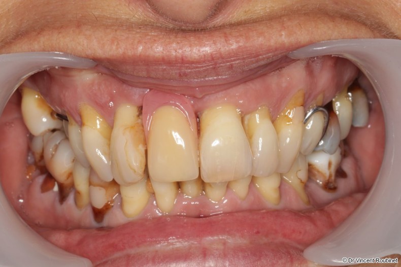 Fig. 1a: Preoperative intra-oral view showing generalised periodontitis.