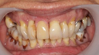 Fully guided full-arch implant rehabilitation with Immediate prefabricated PMMA provisionalisation by “Instant Screwing”