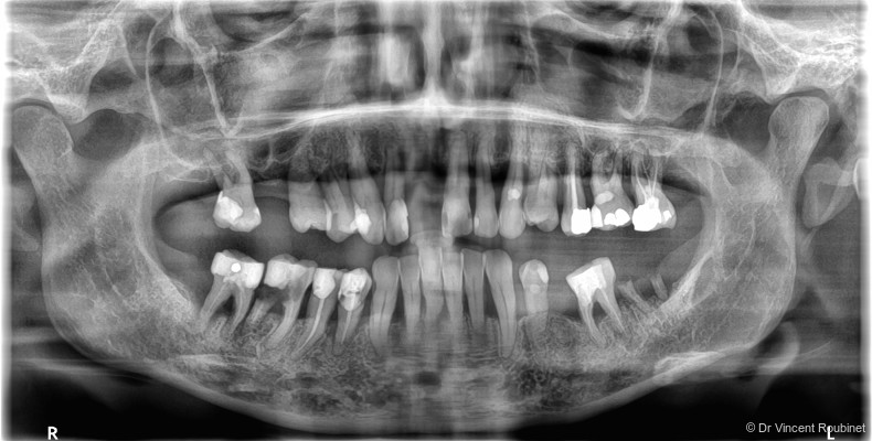 Fig. 1b: Radiographic examination showing generalised bone loss.