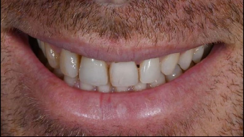 Invisalign Smile Architect™ revolutioniert die KFO und Prothetik ZWP