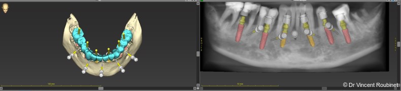 Fig. 2: CoDiagnostiX software used for implant planning.