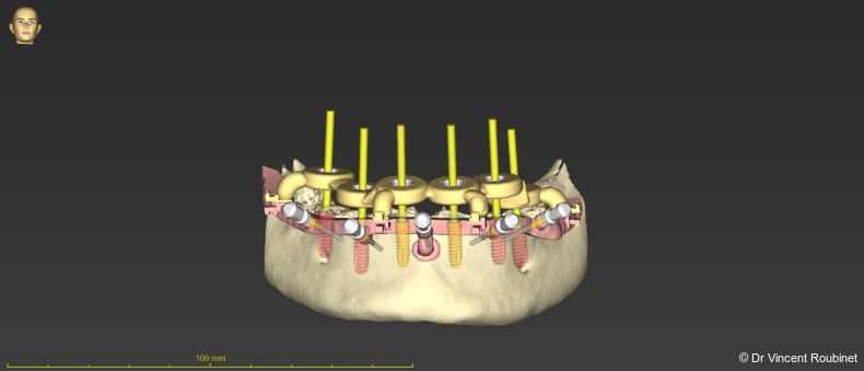 Fig. 3: Design of the metal stackable surgical guide.