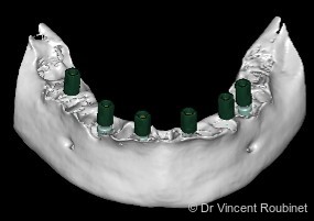 Fig. 4: Virtual impression obtained using scan abutments.