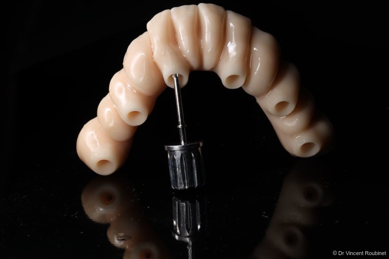Fig. 5: Pre-milled PMMA provisional prosthesis.