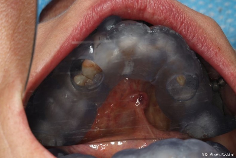 Fig. 6: Tooth-supported guide in position.