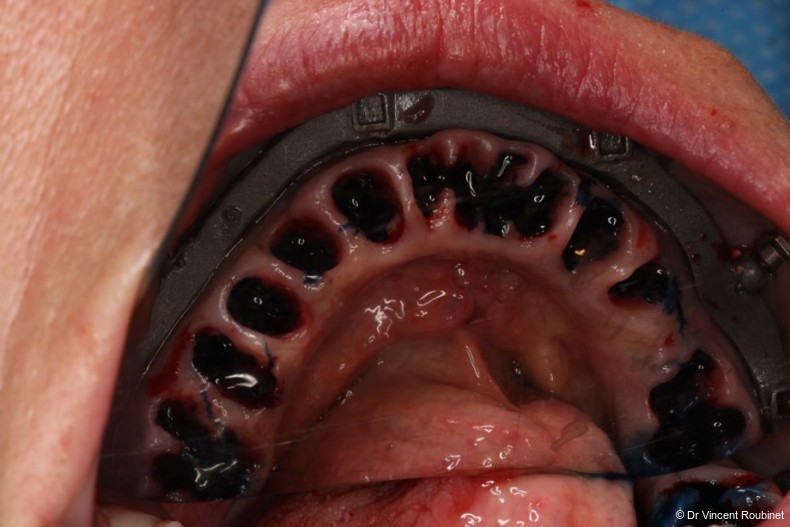 Fig. 7: Atraumatic extractions, curettage, and HELBO aPDT.