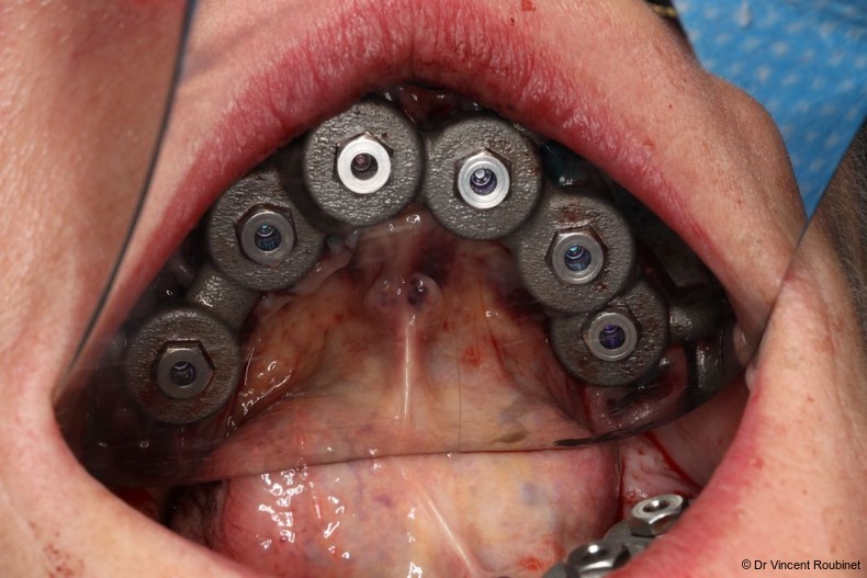 Fig. 9: Guided implant placement.
