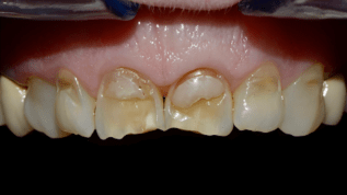 Passung von Laminat-Veneers mit lasergesinterten CAD/CAM-Veneers