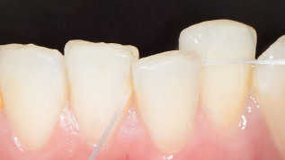 Interdentalraumhygiene – Hilfsmittel und Techniken