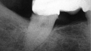Die Bedeutung der präendodontischen Phase bei der Wurzelkanalbehandlung