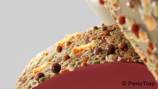 Neue Zahnpasta stoppt Parodontitis-Erreger