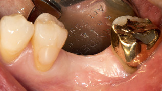 Metallfreie Implantatversorgung im Unterkiefer
