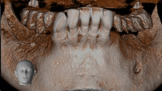 Sicherstellung einer ausreichenden gingivalen Breite um Implantate