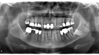 Revisionsbehandlung eines Molaren mit komplexer Anatomie