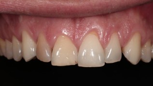 Freie Plätze beim Bösing Dental Teamkurs für Veneertechnik