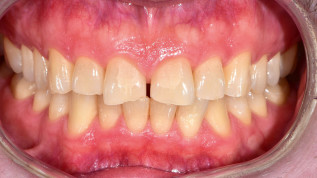 Minimalinvasiv-ästhetische Behandlung mit Alignern und Veneers
