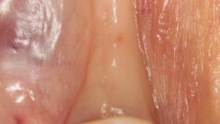 Knochenaugmentation und Implantation