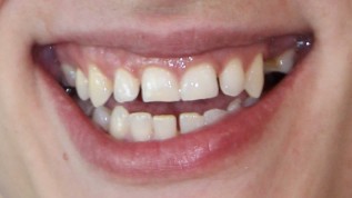 Erfolgreiche Schnittstelle Aligner – Implantologie