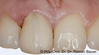 Miesbacher Konzept zur Sofortimplantation